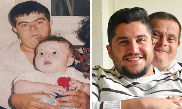 Babai me Sindrom Down e rrit një doktor dhe e vërteton se gjithçka është e mundur