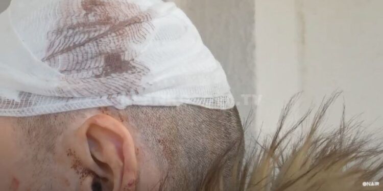 S’u pajtuan për 25 euro, gruaja e rrahu burrin me “resho” e bisht fshese (VIDEO)