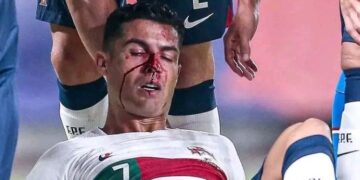 Portieri çek e ‘grushton’ Ronaldon, por pavarësisht gjakosjes e vazhdon ndeshjen (VIDEO)