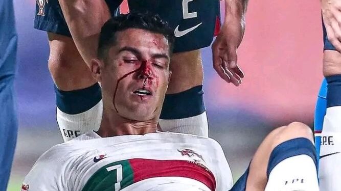 Portieri çek e ‘grushton’ Ronaldon, por pavarësisht gjakosjes e vazhdon ndeshjen (VIDEO)