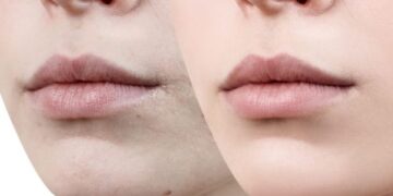 Nëse e vëreni këtë në buzët tuaja, shkoni menjëherë te mjeku