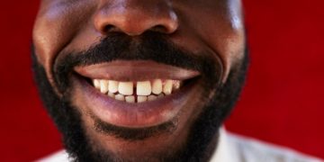 Kjo është shenja e kancerit që mund ta dalloni në gojë