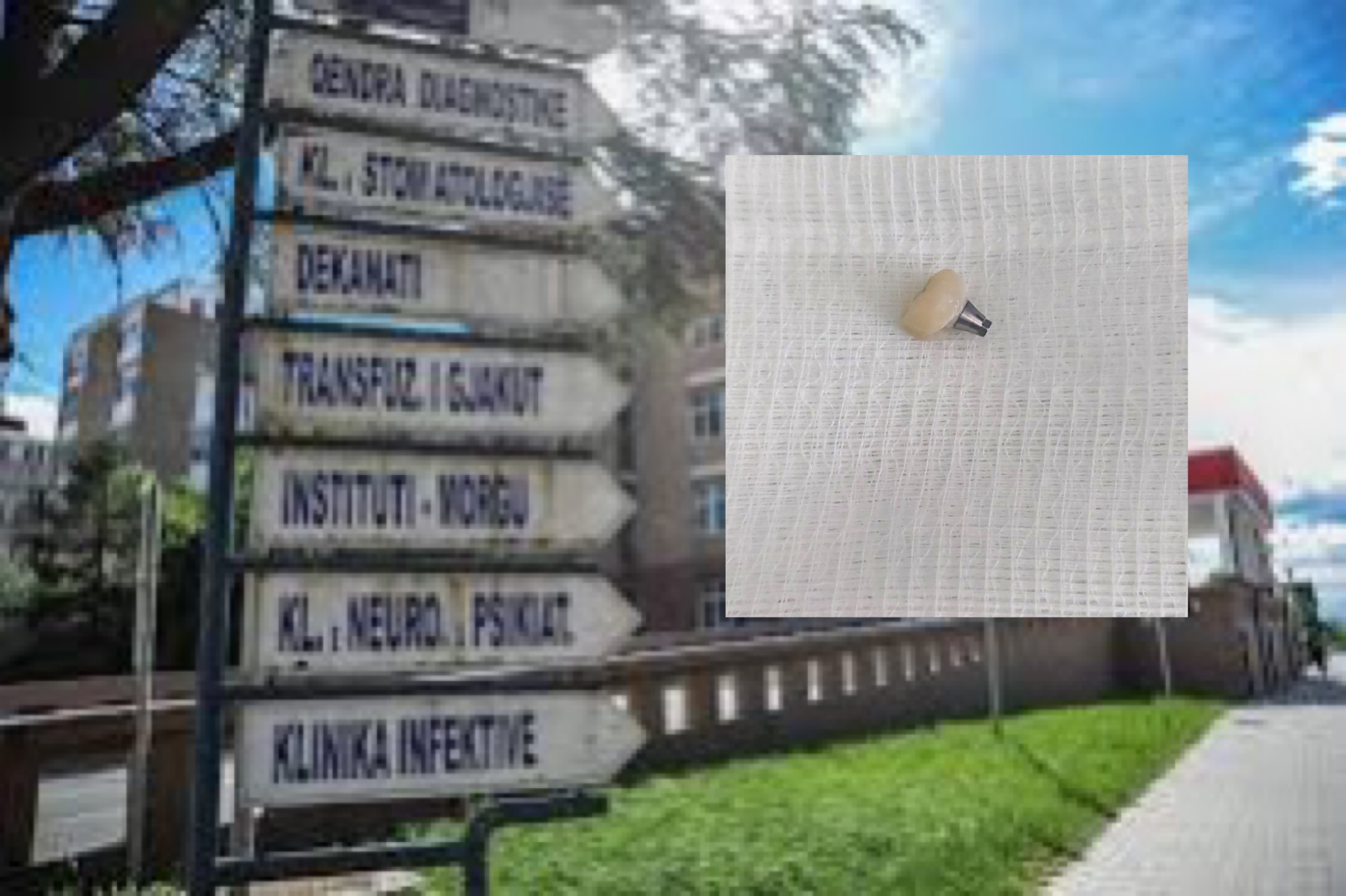 Pacientja gëlltit kurorën e dhëmbëve, mjekët në QKUK ndërhyjnë urgjent dhe ia shpëtojnë jetën