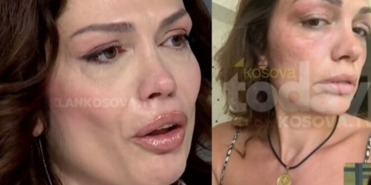 Publikohen fotot: Kështu u rrah ish-miss Kosova nga burri i saj