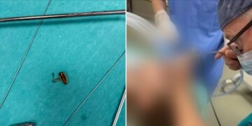 Një 5-vjeçari i hiqet në QKUK fara e lulediellit, që ia bllokoi rrugët e frymëmarrjes