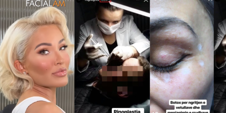Dolce bën fillera te “doktoresha” e VIP-ave, Dr. Linda që pa diplomë e pa licencë “mjeshtroi” për disa vite me botox e fillera fytyrat e femrave në Prishtinë