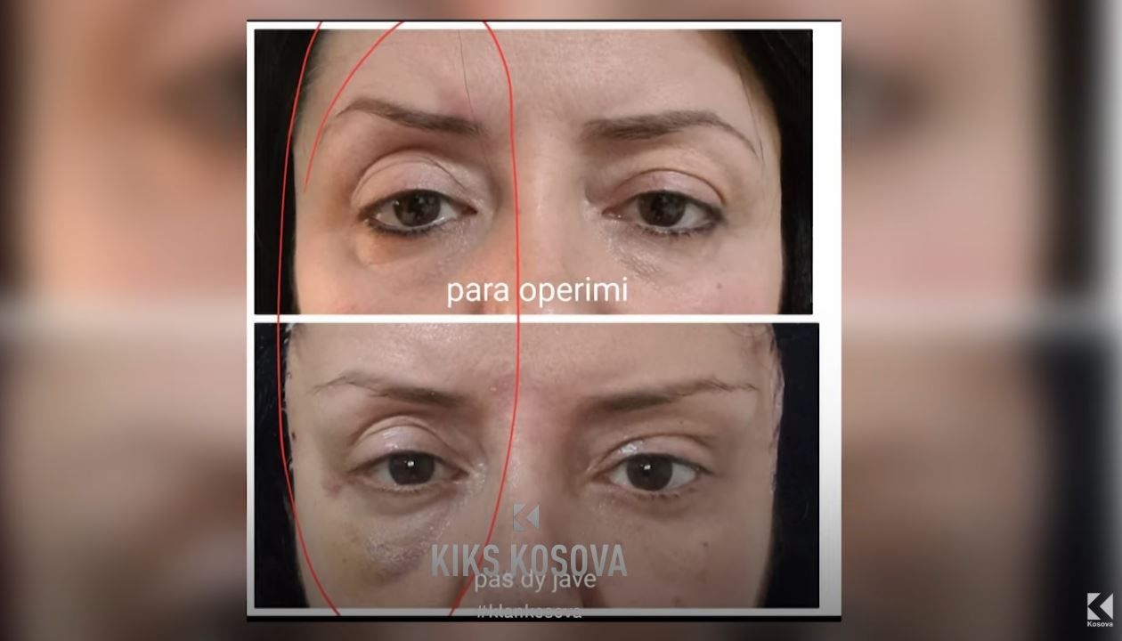 “M’ka kesh në fytyrë”: Pacientja akuzon drejtorin e Spitalit “Aloka” për shpërfillje (VIDEO)