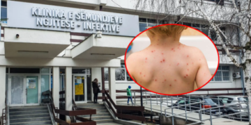IKSHPK: Për një muaj janë konfirmuar 14 raste të fruthit, vaksinoni fëmijët – rreziku për komplikime është serioz
